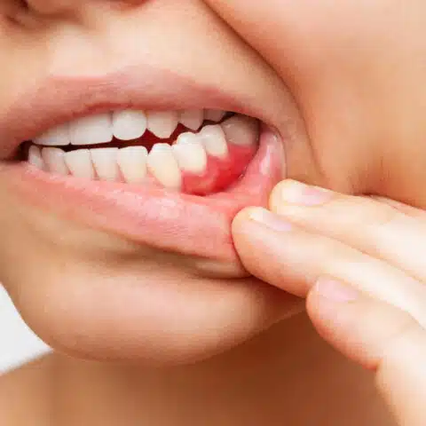 Cropped shot of a young woman showing red bleeding gums isolated on a white background