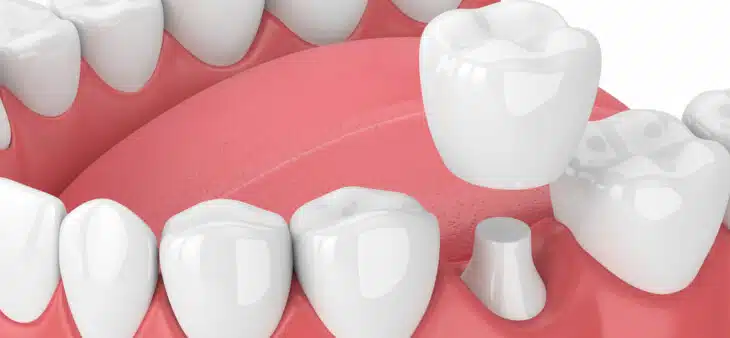 3d render of jaw with teeth and dental crown restoration over white background