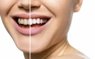 Teeth before and after teeth whitening