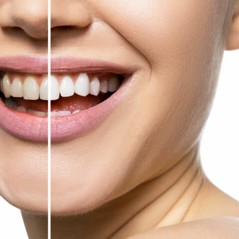 Teeth before and after teeth whitening