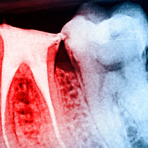 X-ray showing infected tooth needing root canal treatment