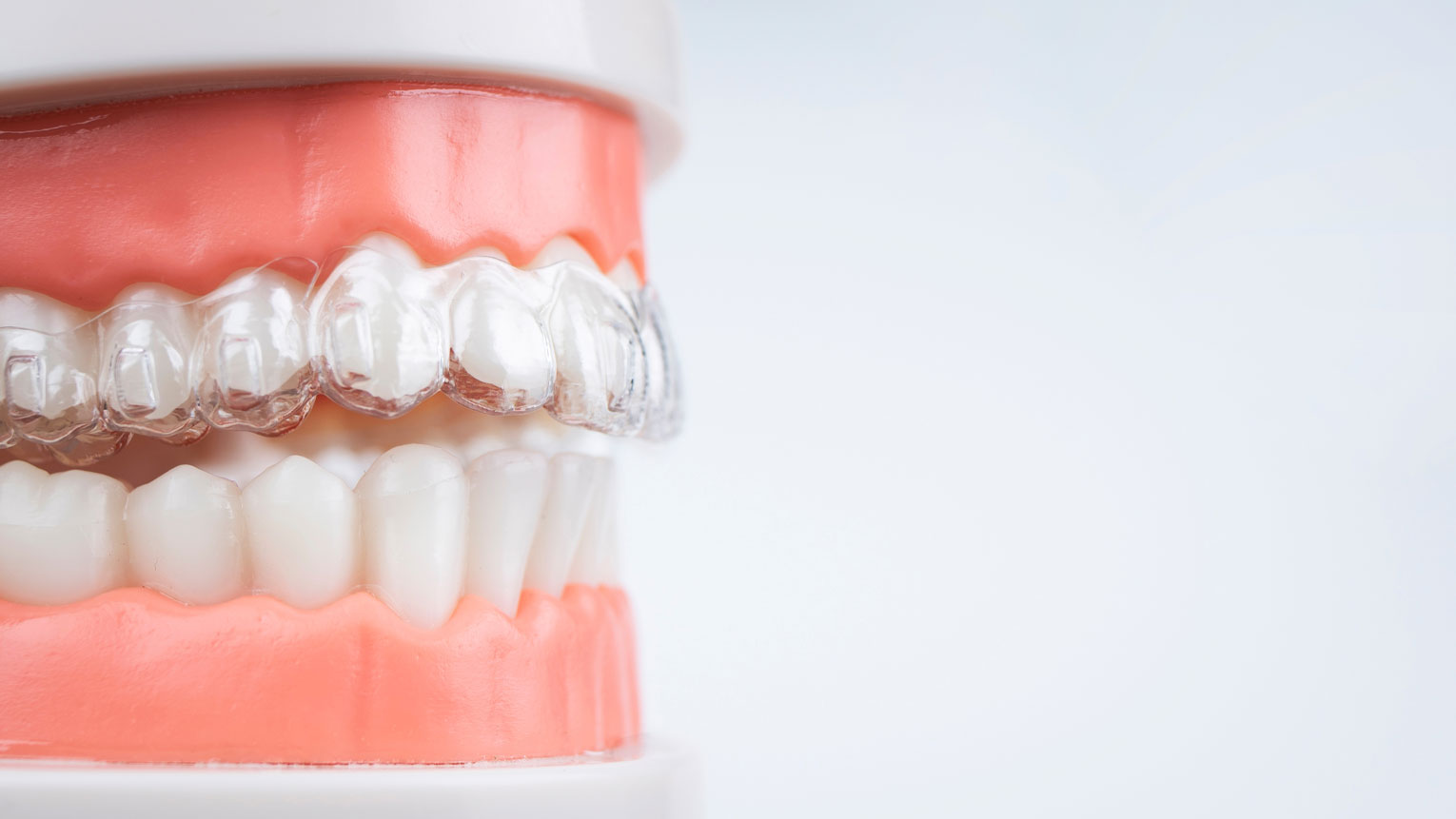 Are At-Home Clear Aligners Right for You?