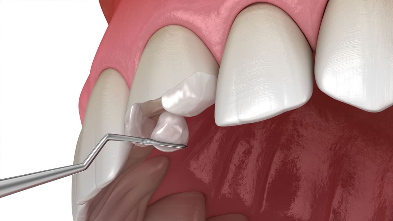 Can Broken Teeth Cause Dental Problems?
