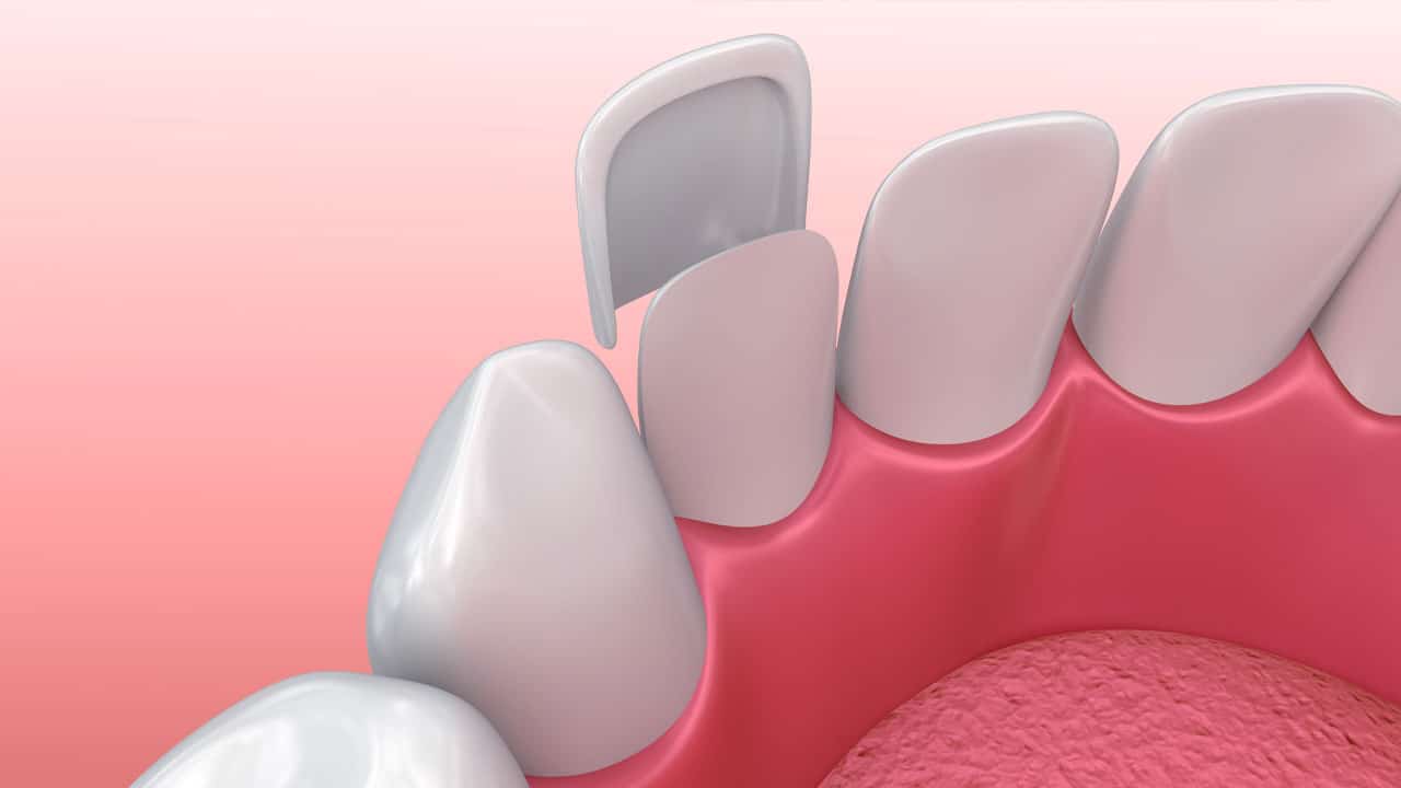 Dental veneers