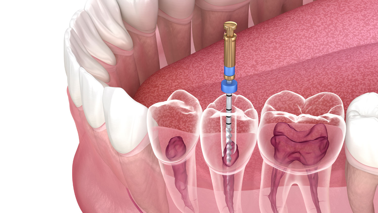 Root Canal Recovery Time What to Expect